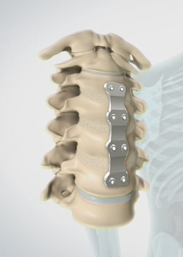 Anterior Cervical Corpectomy And Fusion