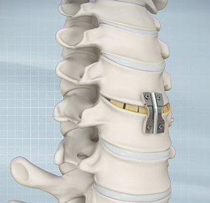 Anterior Cervical Discectomy 