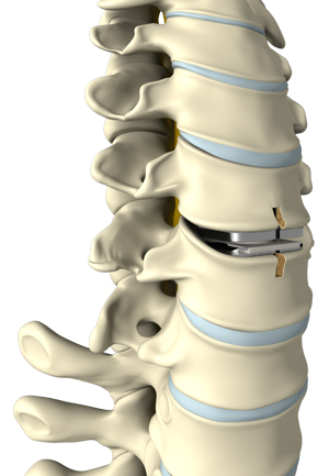 Artificial Cervical Disc Replacement