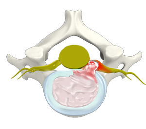 Herniated Disc (Cervical)