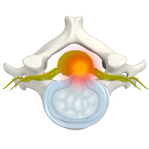  Cervical Disc Protrusion