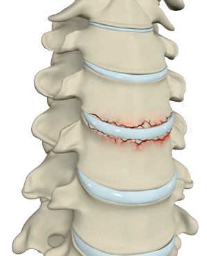  Cervical Fracture