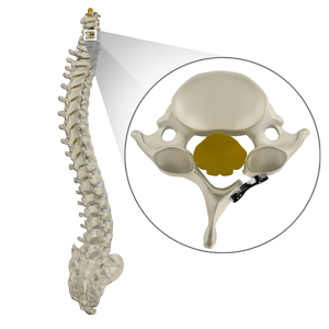 Cervical Laminoplasty