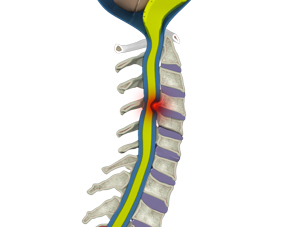  Cervical Myelopathy