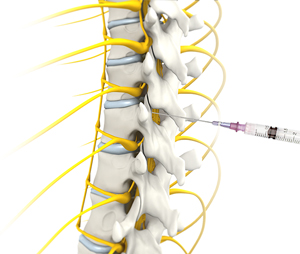 Herniated disc (Cervical)