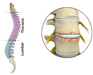 Fracture of the Thoracic and Lumbar Spine