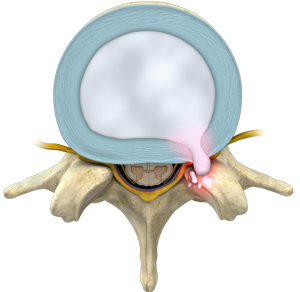 Lumbar Stenosis