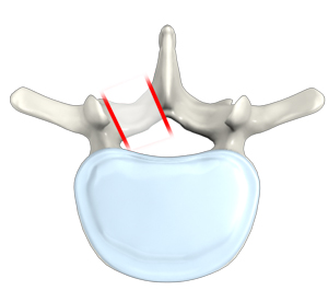 Foraminotomy (Lumbar and Cervical) 