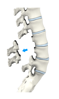 Lumbar and Cervical Laminectomy