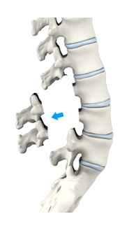  Lumbar and Cervical Laminectomy 