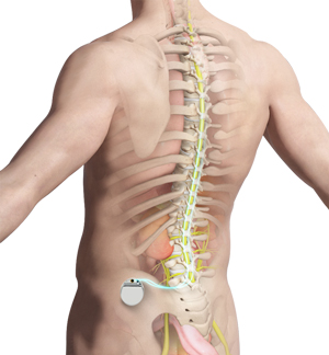 Spinal Cord Stimulator New York  Back Pain Treatment Staten Island, New  York