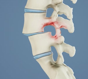  Spondylolisthesis 