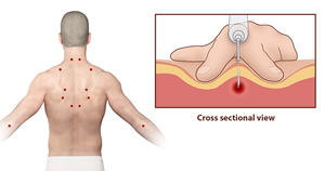 trigger point steroid injections