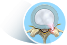 Herniated Disc