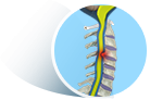 Myelopathy