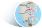 Spondylolisthesis